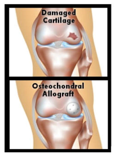 Two 3D models of a knee joint stacked on top of each other. The first shows damaged cartilage and the second shows the knee after an osteochondral allograft