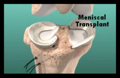 A 3D model of a knee joint that shows the implant after a meniscal transplant.